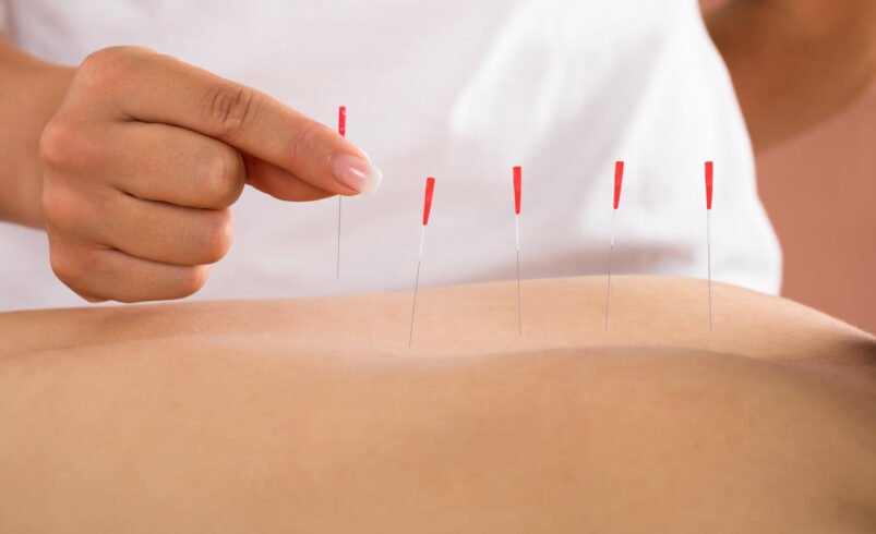 6 Dry Needling Benefits For Body Pain & Soreness Relief
