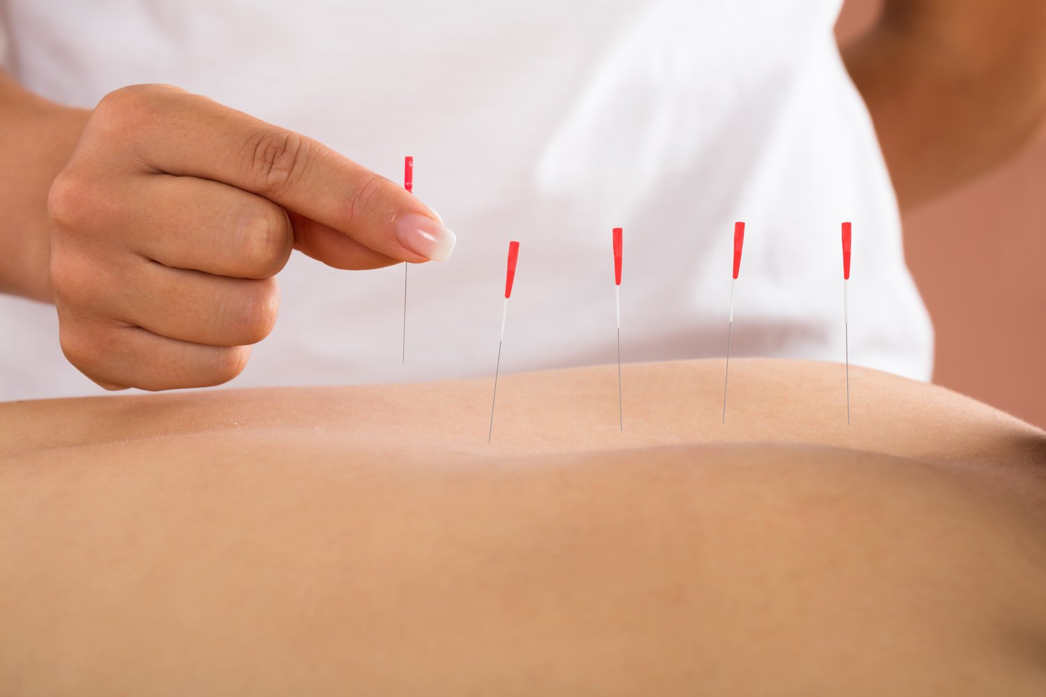 6 Dry Needling Benefits For Body Pain & Soreness Relief