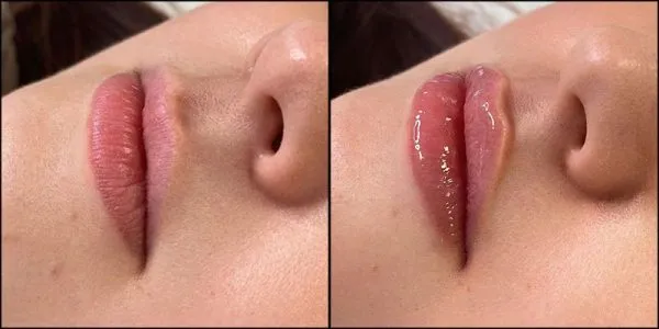 Russian Lip Fillers vs. Other Techniques: Check The Comparison