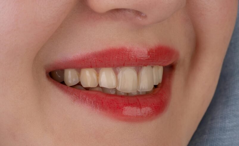 Cosmetic Dental Improvements