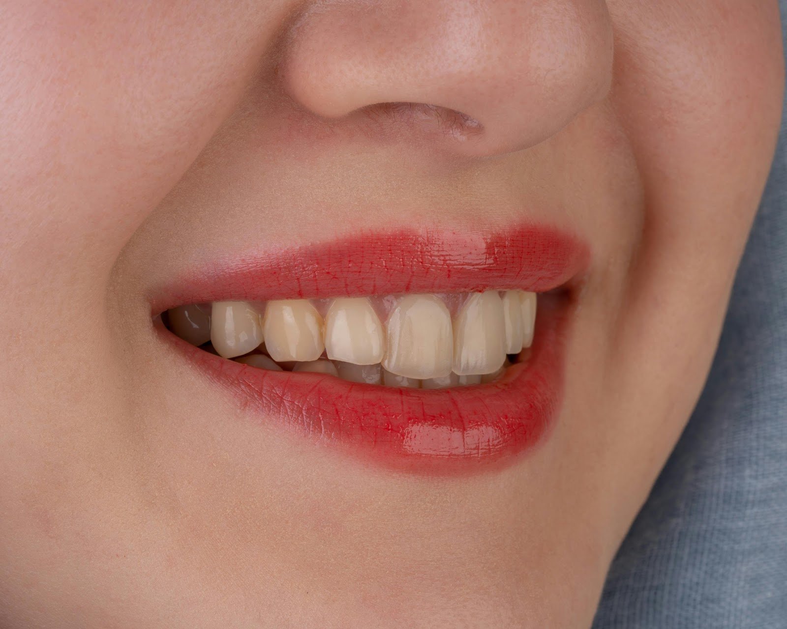 Top 5 Reasons to Choose Composite Bonding for Cosmetic Dental Improvements