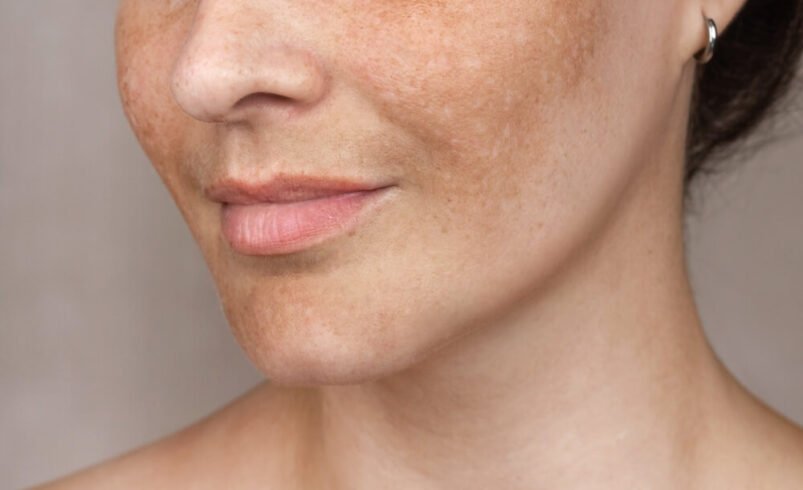 Facial Melasma