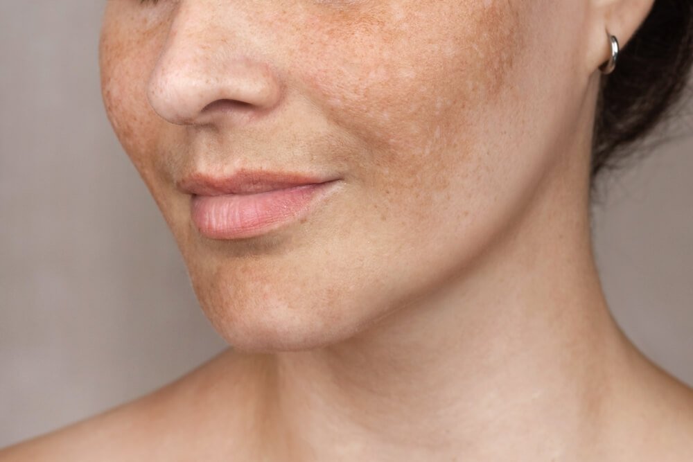 Facial Melasma